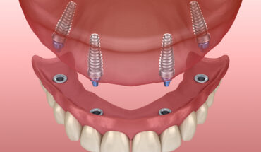all on four dental implants