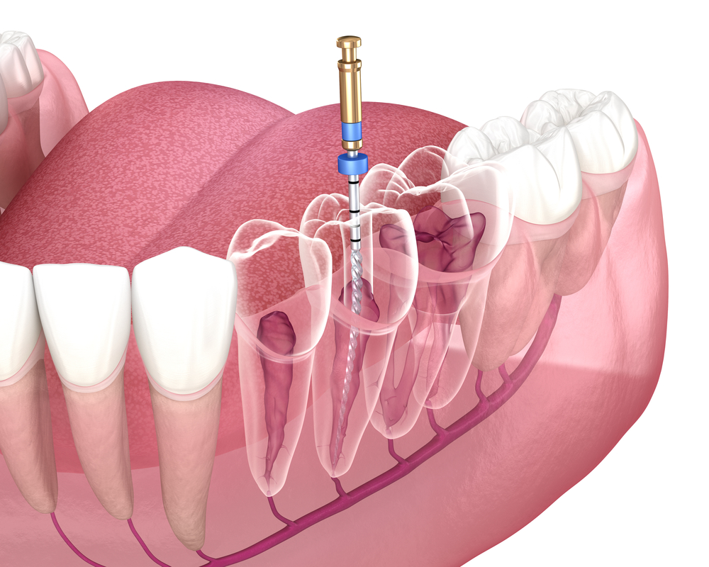 root canals