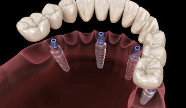 All-on-4 dental implants