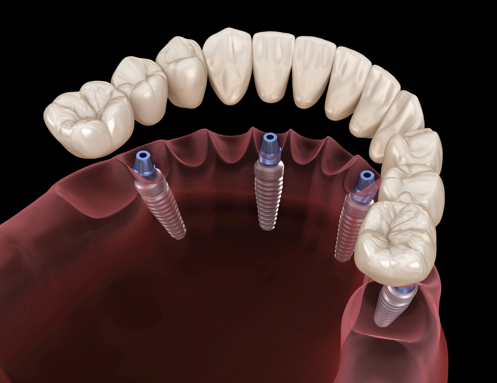 All-on-4 dental implants