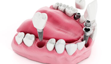 dental implants