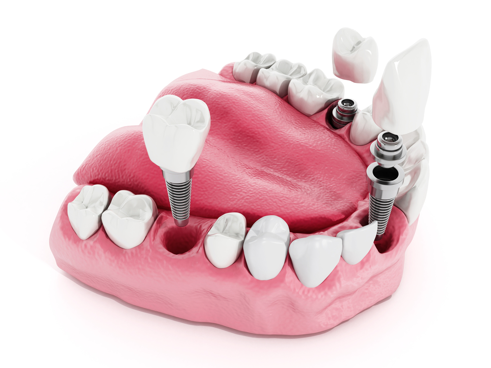 dental implants