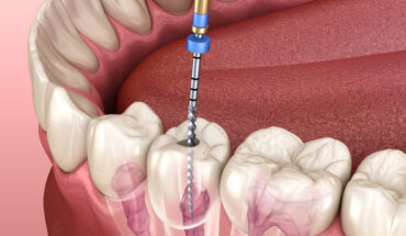 root canal treatments