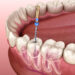 root canal treatments