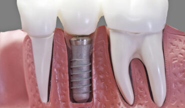 dental implants