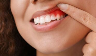 Gum Disease Impacts Overall Health