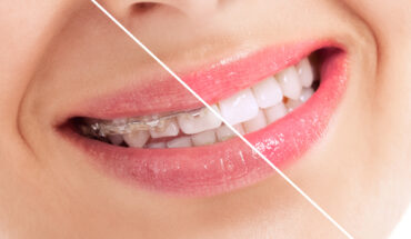 Cosmetic dentistry