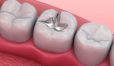 dental fillings