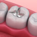 dental fillings