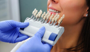 porcelain veneers