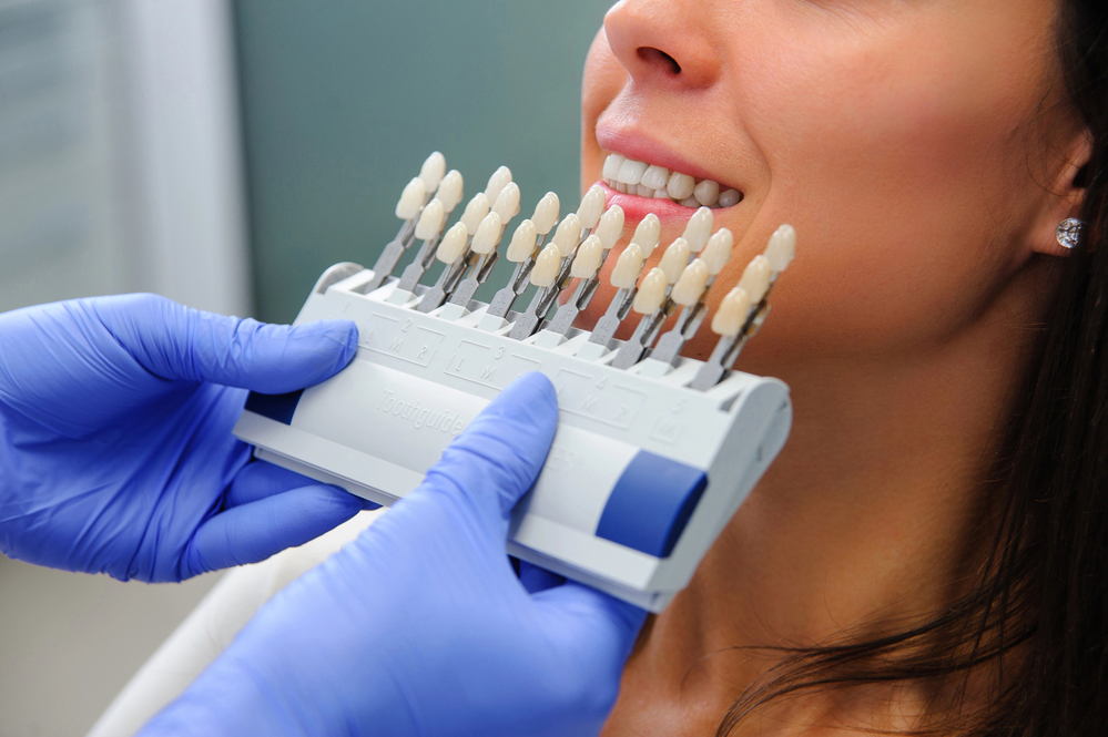 porcelain veneers