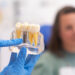 dental implants