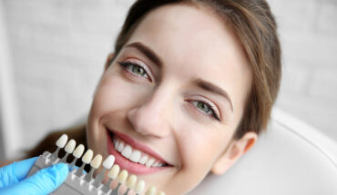 Porcelain veneers