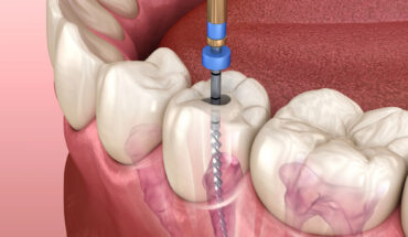 root canal