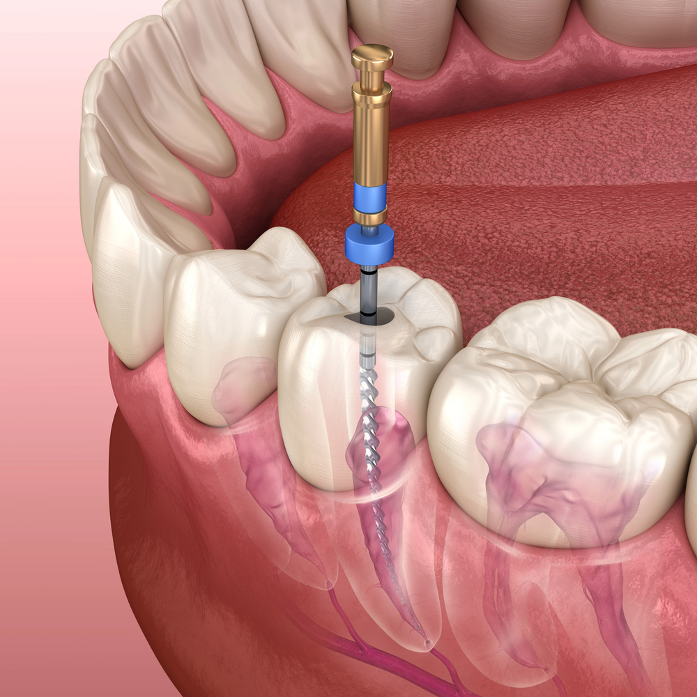 root canal