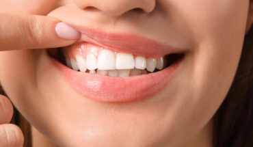 Healthy Gums