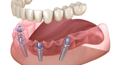 All-On-4 dental implants