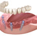 All-On-4 dental implants