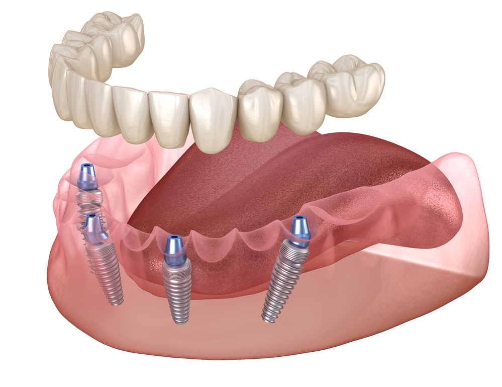 All-On-4 dental implants