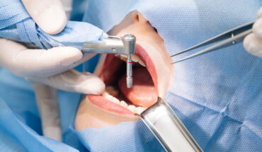 Modern dental implants
