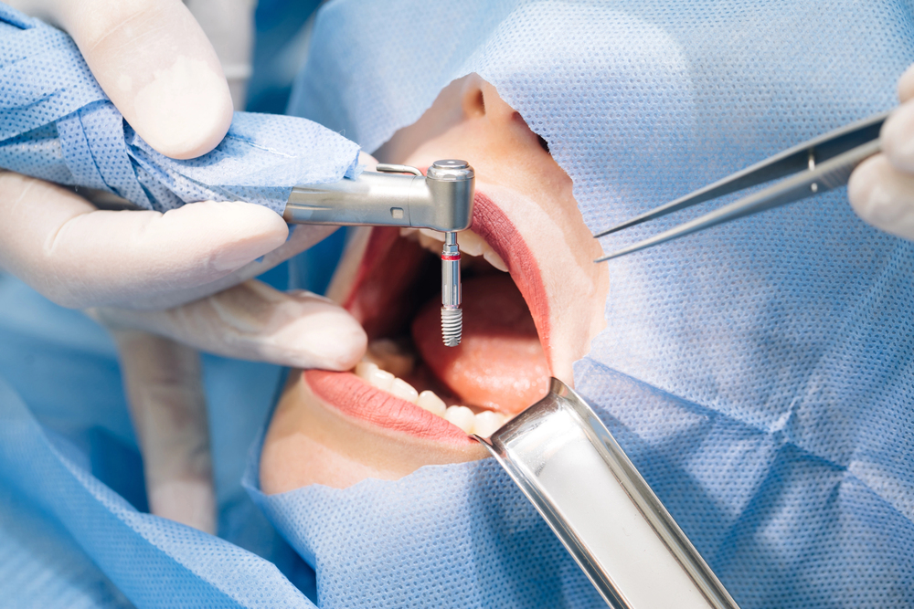 Modern dental implants